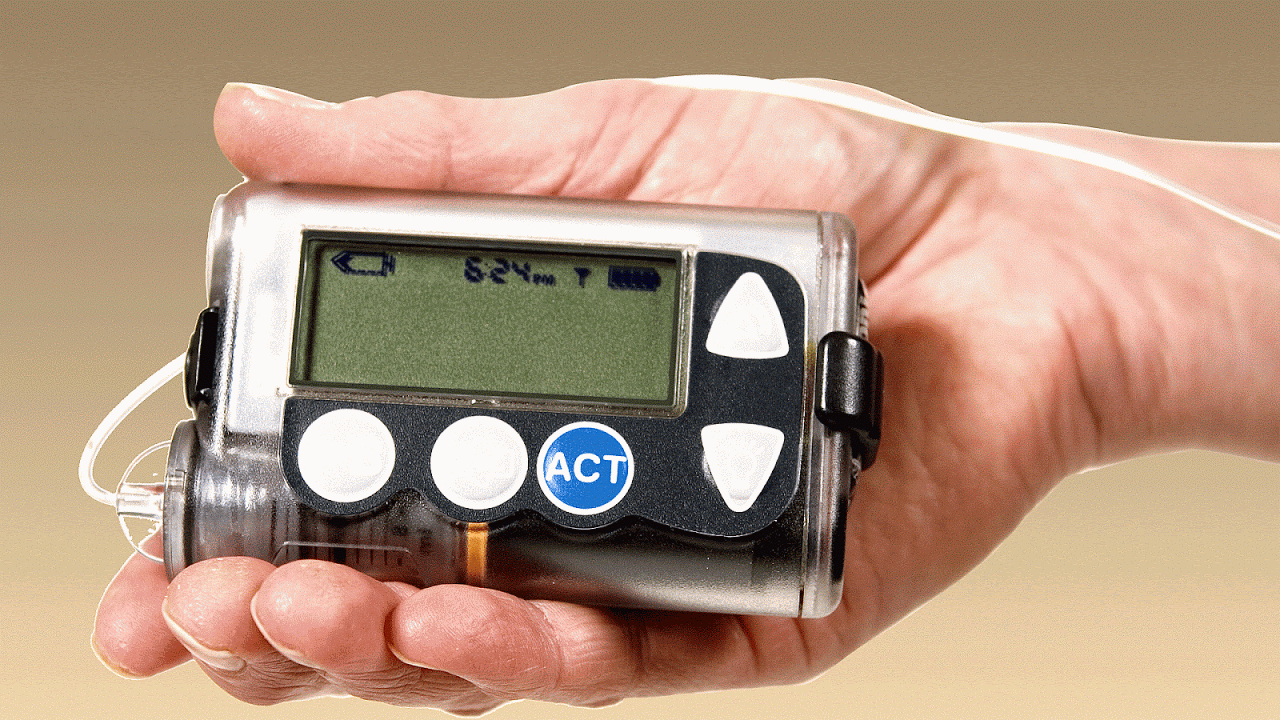 Pompa insulinowa – jak działa, wady, zalety, ile kosztuje?